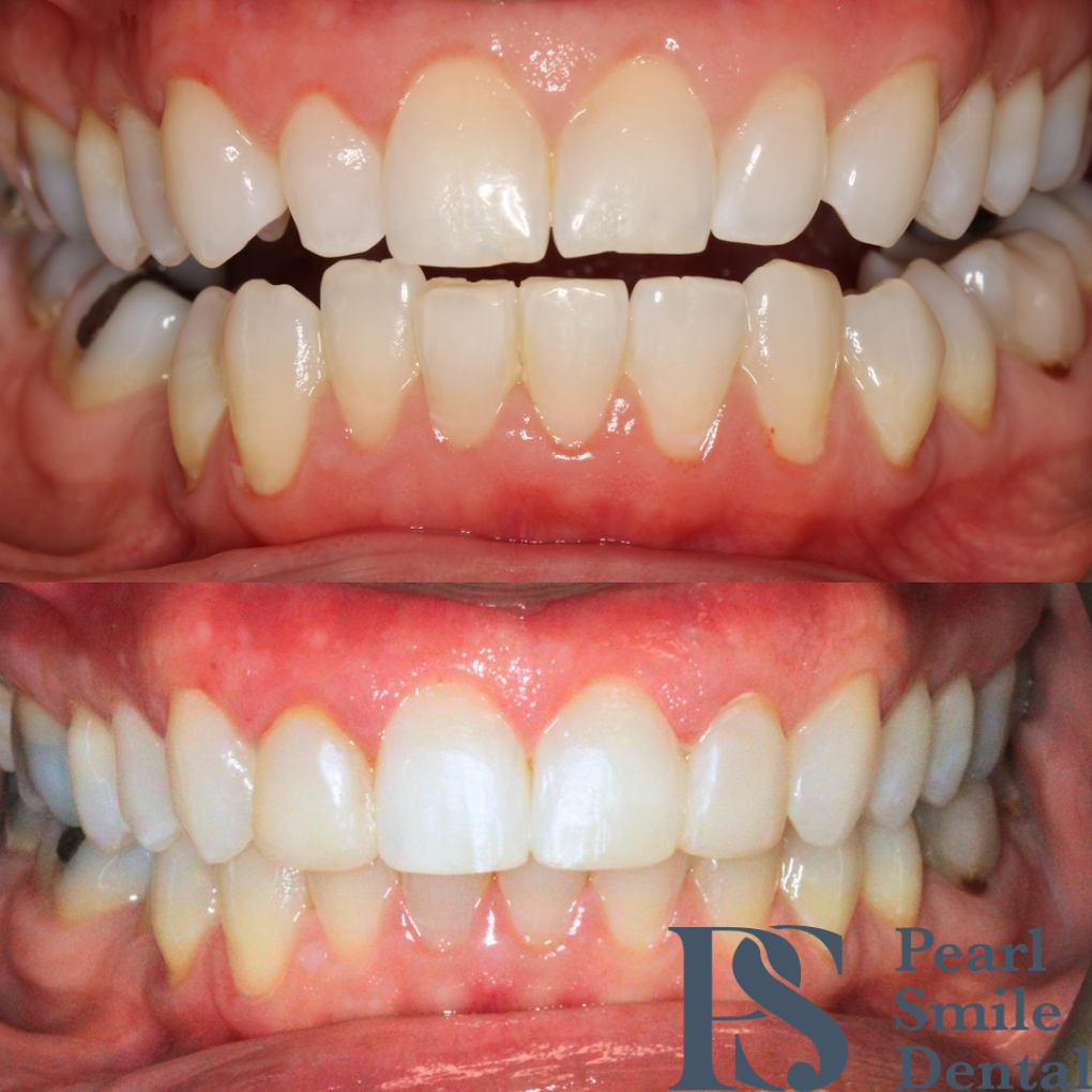 Pearl Smile Prestbury | Composite Bonding in Bromley Cross