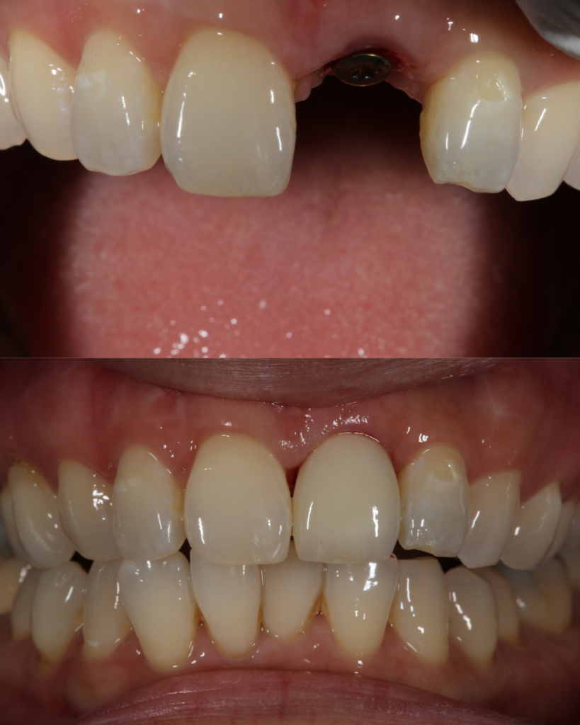 Pearl Smile Prestbury|Dental Implants