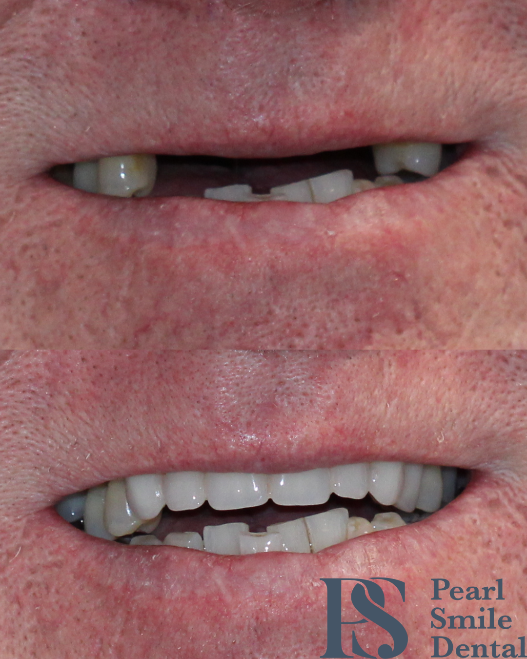 Pearl Smile Prestbury | Dentures