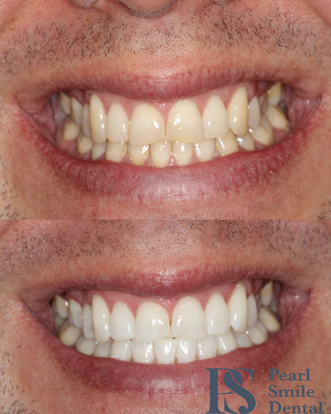 Pearl Smile Prestbury | Teeth Whitening