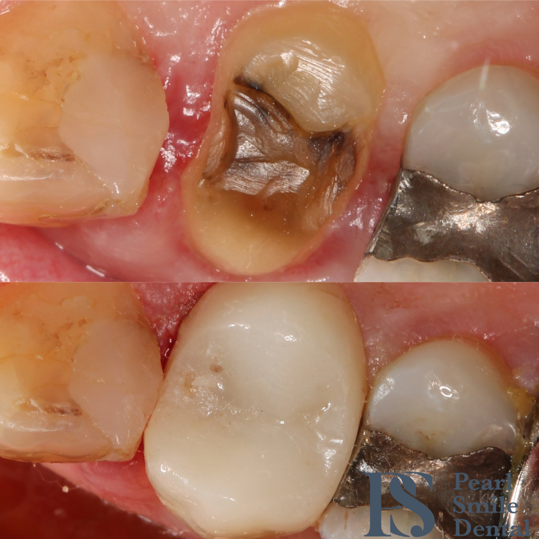 Pearl Smile Prestbury | Dental Crowns